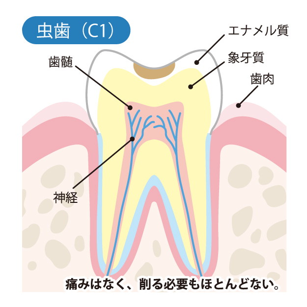 武蔵小杉の歯医者、武蔵小杉ネゴ歯科矯正歯科で虫歯治療