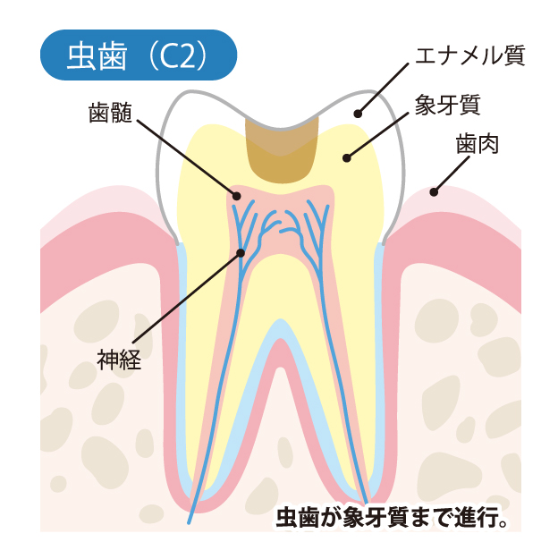 武蔵小杉の歯医者、武蔵小杉ネゴ歯科矯正歯科で虫歯治療