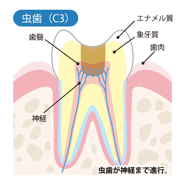 武蔵小杉の歯医者、武蔵小杉ネゴ歯科矯正歯科で虫歯治療