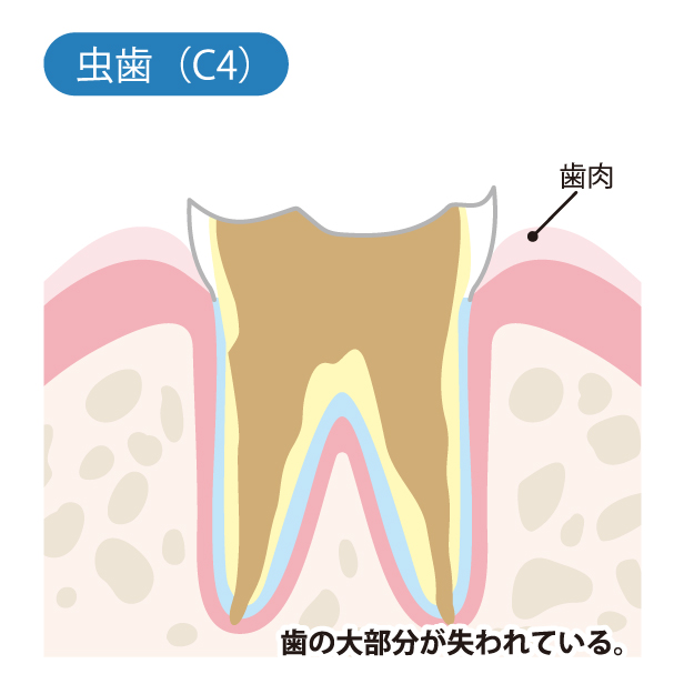 武蔵小杉の歯医者、武蔵小杉ネゴ歯科矯正歯科で虫歯治療