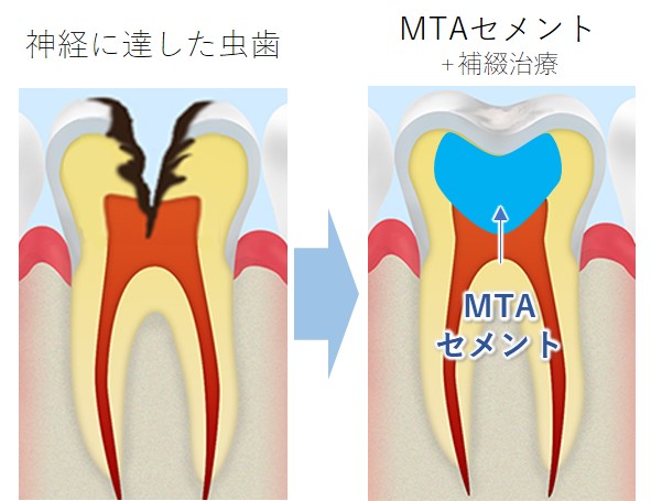 武蔵小杉の歯医者、武蔵小杉ネゴ歯科矯正歯科のなるべく削らず歯を守る治療