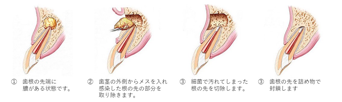 武蔵小杉ネゴ歯科矯正歯科の精密根管治療