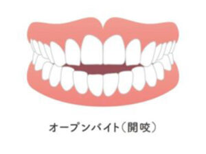 武蔵小杉ネゴ歯科矯正歯科であごに梅干しジワができる原因と改善方法について解説