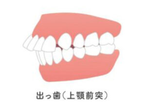 武蔵小杉ネゴ歯科矯正歯科であごに梅干しジワができる原因と改善方法について解説