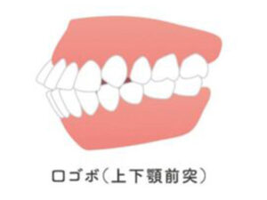 武蔵小杉ネゴ歯科矯正歯科であごに梅干しジワができる原因と改善方法について解説