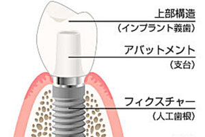 武蔵小杉ネゴ歯科矯正歯科でインプラントがぐらついている場合の対処法と原因をを解説