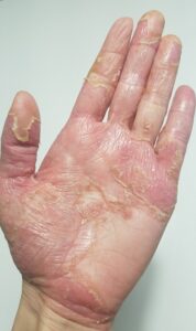 武蔵小杉の歯医者、武蔵小杉ネゴ歯科矯正歯科で掌蹠膿疱症について解説