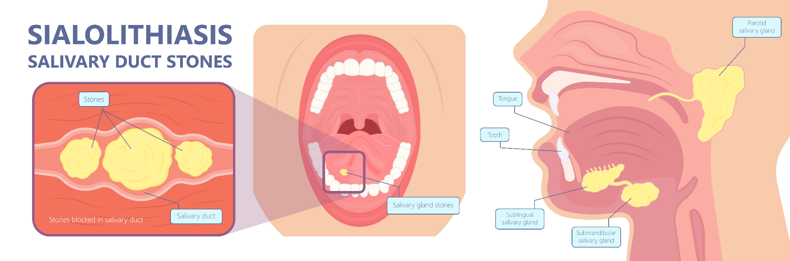 武蔵小杉ネゴ歯科矯正歯科で唾石症について解説