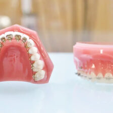 武蔵小杉の歯医者、武蔵小杉ネゴ歯科矯正歯科でハーフリンガル矯正って何？特徴やメリット・デメリットを解説