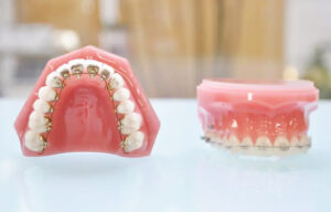 武蔵小杉の歯医者、武蔵小杉ネゴ歯科矯正歯科でハーフリンガル矯正って何？特徴やメリット・デメリットを解説