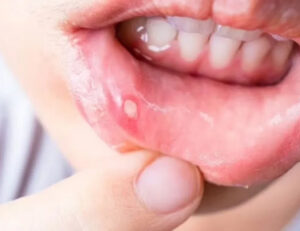 武蔵小杉の歯医者、武蔵小杉ネゴ歯科矯正歯科で舌にできるしこりやできものの原因と受診のタイミングについて解説