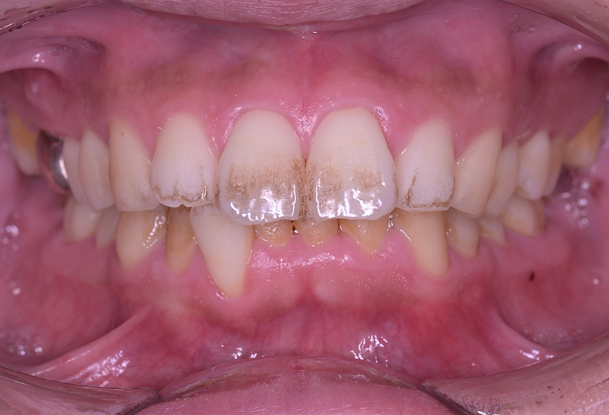 武蔵小杉の歯医者、武蔵小杉ネゴ歯科矯正歯科のエアフロー症例