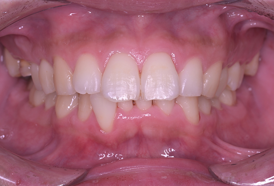 武蔵小杉の歯医者、武蔵小杉ネゴ歯科矯正歯科のエアフロー症例