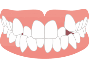 武蔵小杉の歯医者、武蔵小杉ネゴ歯科矯正歯科でハーフリンガル矯正って何？特徴やメリット・デメリットを解説