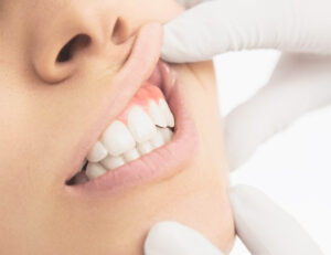 武蔵小杉の歯医者、武蔵小杉ネゴ歯科矯正歯科で歯肉ホワイトニングについて解説