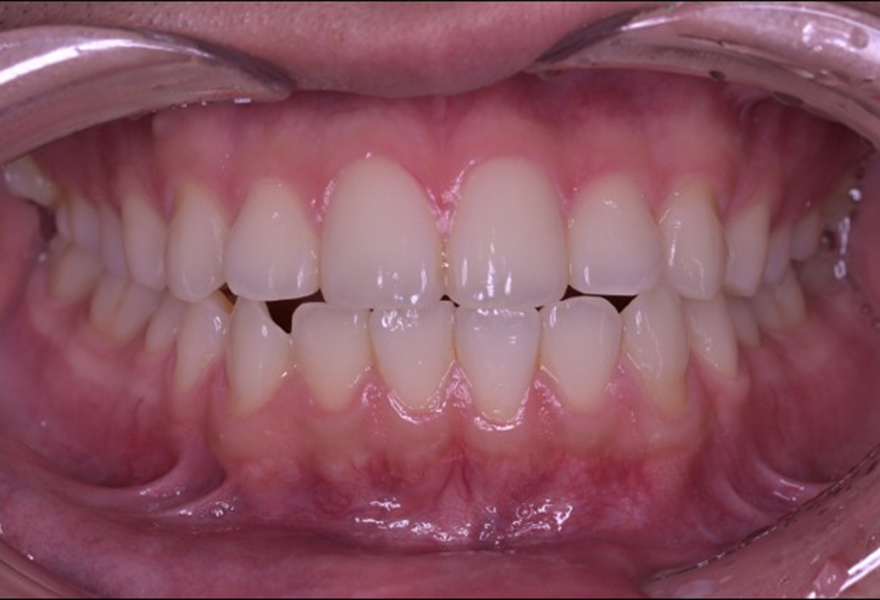 武蔵小杉ネゴ歯科矯正歯科のオフィスホワイトニング症例