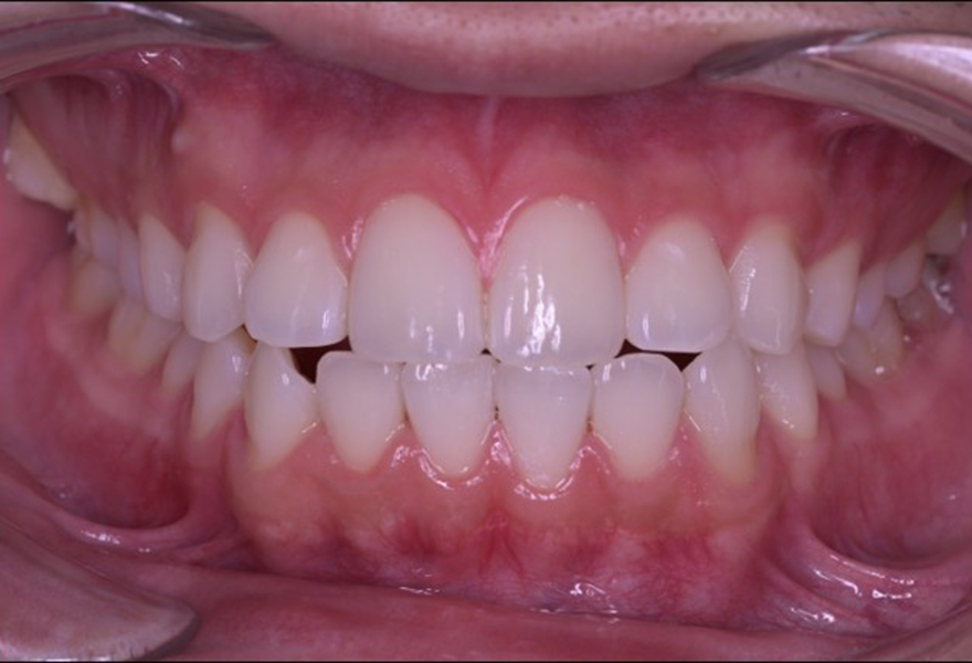 武蔵小杉ネゴ歯科矯正歯科のオフィスホワイトニング症例