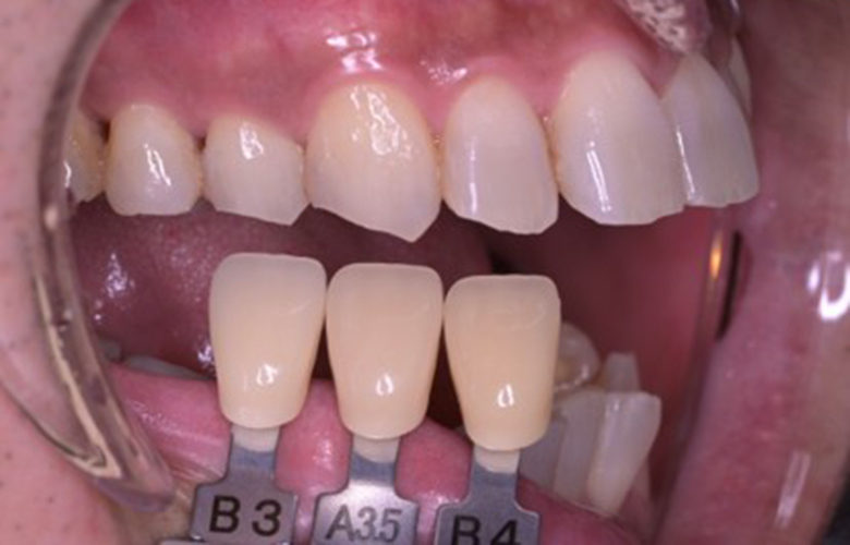 武蔵小杉ネゴ歯科矯正歯科のオフィスホワイトニング症例