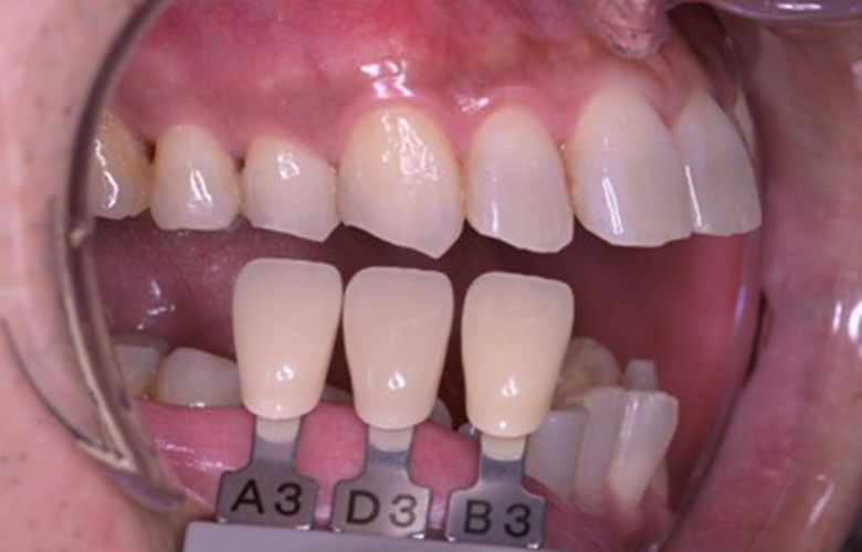 武蔵小杉ネゴ歯科矯正歯科のオフィスホワイトニング症例