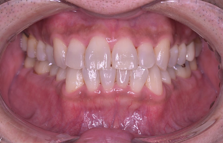 武蔵小杉ネゴ歯科矯正歯科のオフィスホワイトニング症例