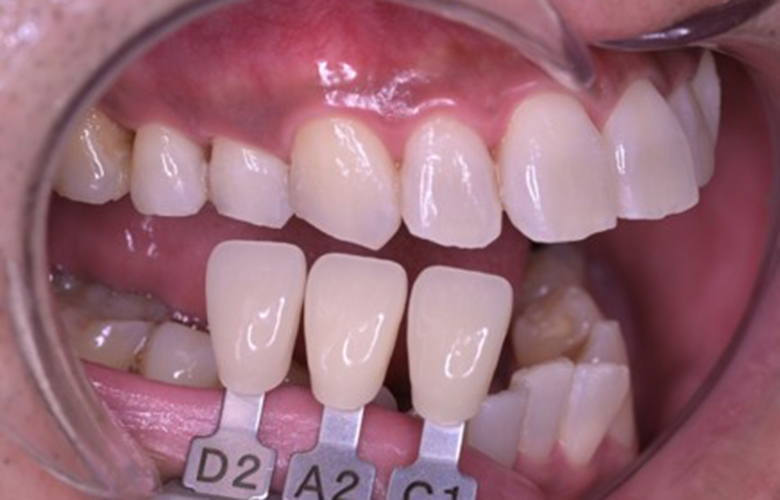 武蔵小杉ネゴ歯科矯正歯科のオフィスホワイトニング症例