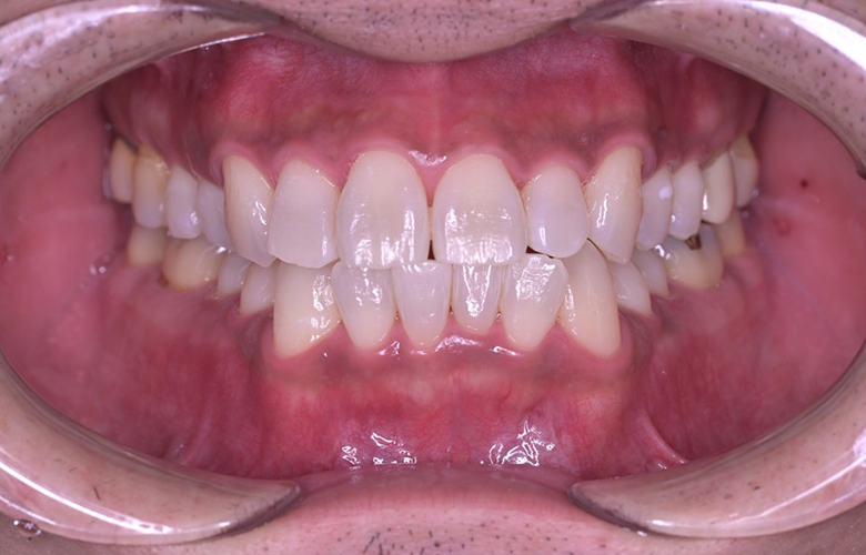 武蔵小杉ネゴ歯科矯正歯科のオフィスホワイトニング症例