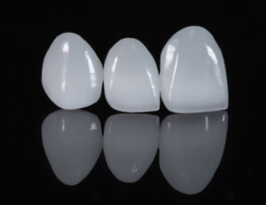 武蔵小杉の歯医者、武蔵小杉ネゴ歯科矯正歯科で「ダイレクトボンディング」と「ラミネートベニア」の違いについて解説