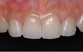 武蔵小杉の歯医者、武蔵小杉ネゴ歯科矯正歯科で「ダイレクトボンディング」と「ラミネートベニア」の違いについて解説