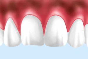 武蔵小杉の歯医者、武蔵小杉ネゴ歯科矯正歯科で歯肉ホワイトニングについて解説