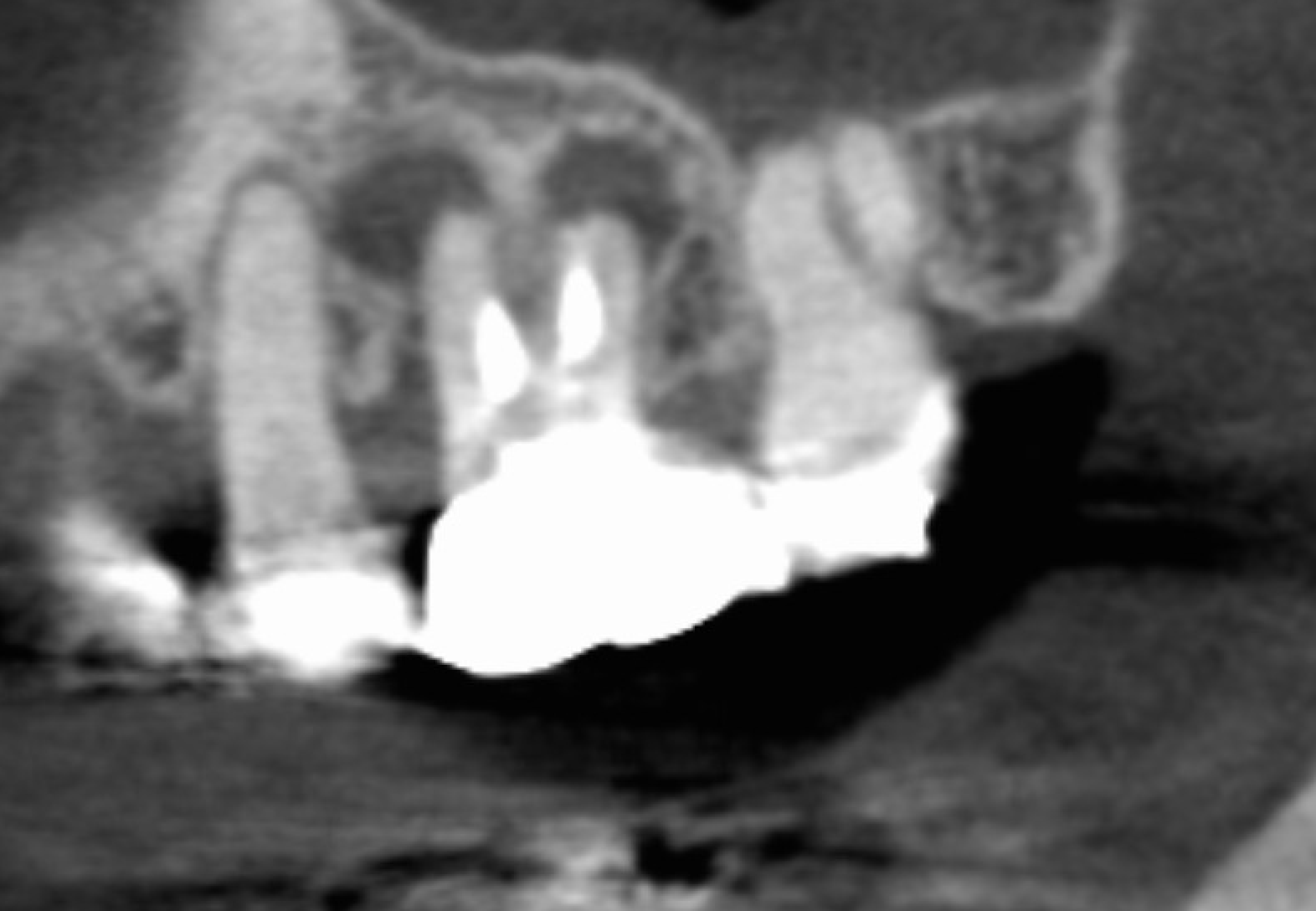 武蔵小杉ネゴ歯科矯正歯科の症例