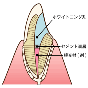 武蔵小杉の歯医者、武蔵小杉ネゴ歯科矯正歯科で歯髄壊死が進むと歯の色が変化する理由と内部吸収の進行について