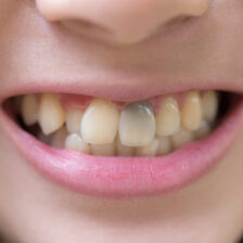 武蔵小杉の歯医者、武蔵小杉ネゴ歯科矯正歯科で歯髄壊死が進むと歯の色が変化する理由と内部吸収の進行について