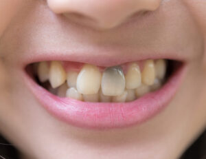 武蔵小杉の歯医者、武蔵小杉ネゴ歯科矯正歯科で歯髄壊死が進むと歯の色が変化する理由と内部吸収の進行について