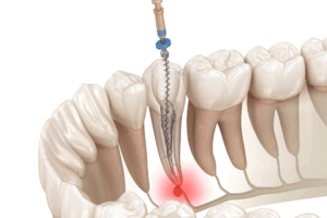 武蔵小杉の歯医者、武蔵小杉ネゴ歯科矯正歯科で歯髄壊死が進むと歯の色が変化する理由と内部吸収の進行について
