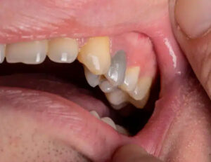 武蔵小杉の歯医者、武蔵小杉ネゴ歯科矯正歯科で歯髄壊死が進むと歯の色が変化する理由と内部吸収の進行について