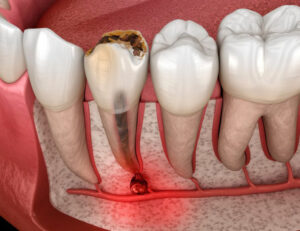 武蔵小杉の歯医者、武蔵小杉ネゴ歯科矯正歯科で歯髄壊死が進むと歯の色が変化する理由と内部吸収の進行について