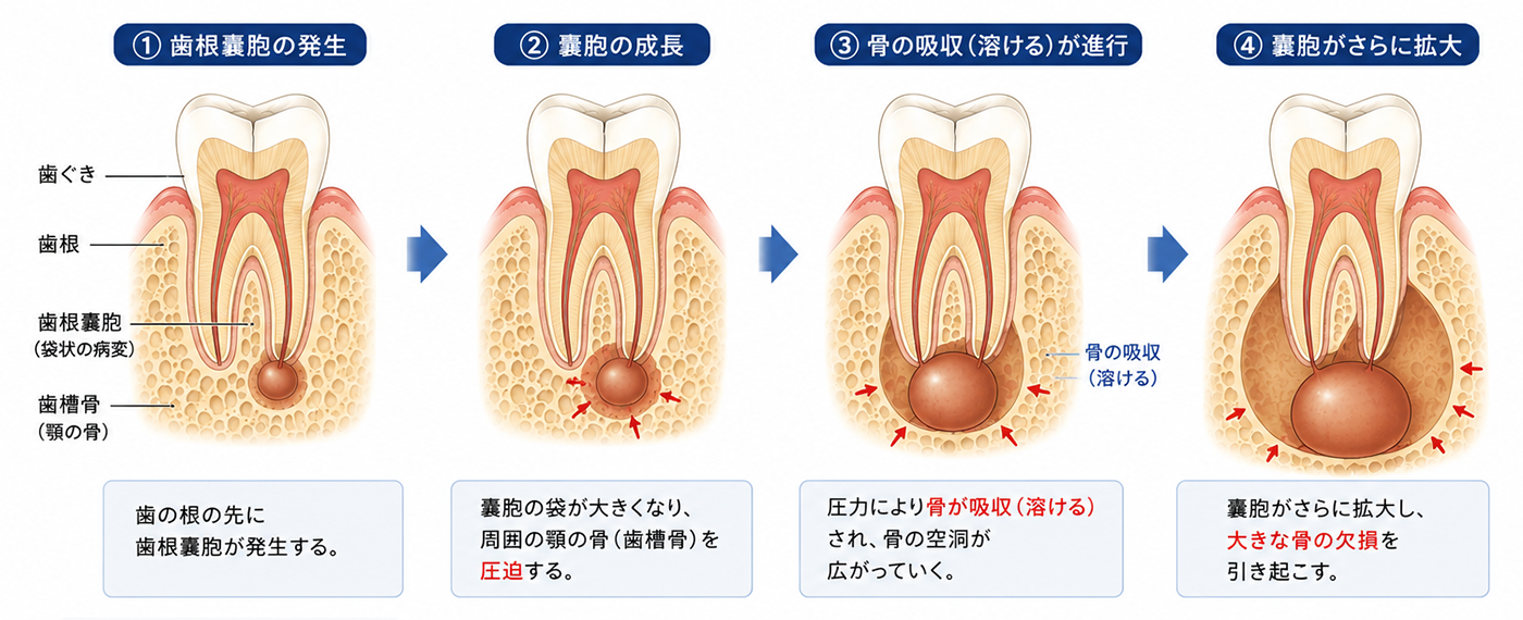 武蔵小杉の歯医者、武蔵小杉ネゴ歯科矯正歯科で昔治療した歯の根元が腫れてきた？根尖性歯周炎と再治療のタイミングを解説